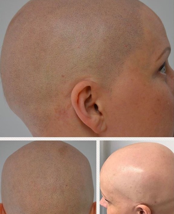 Scalp Micropigmentation for Alocpecia