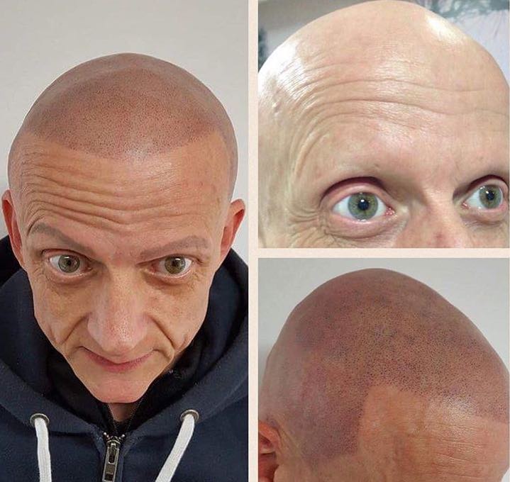 Alopecia 2