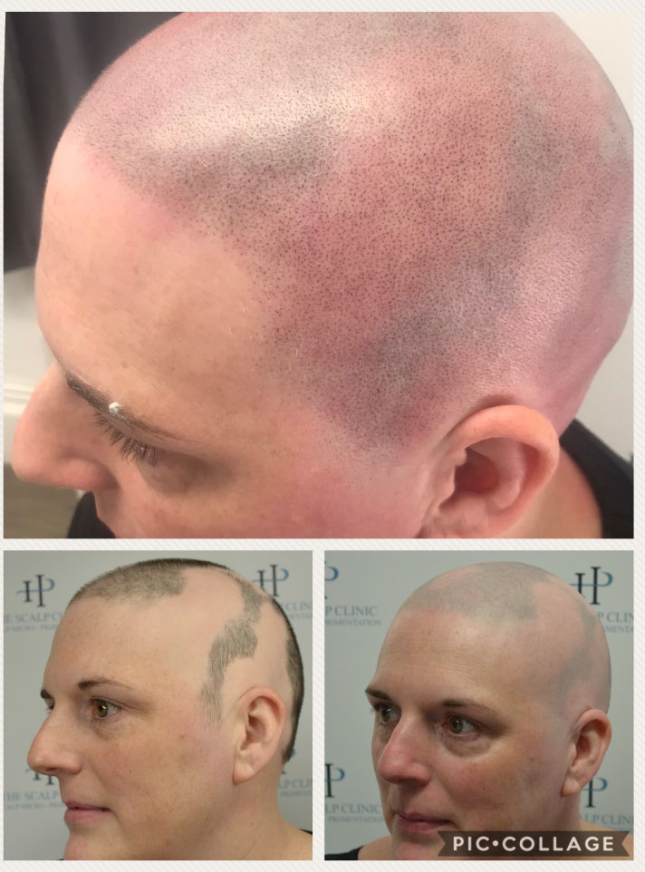 Scalp Micropigmentation for Alocpecia