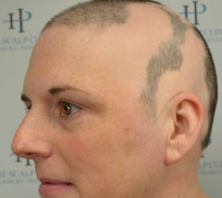 Scalp Micropigmentation for Alopecia