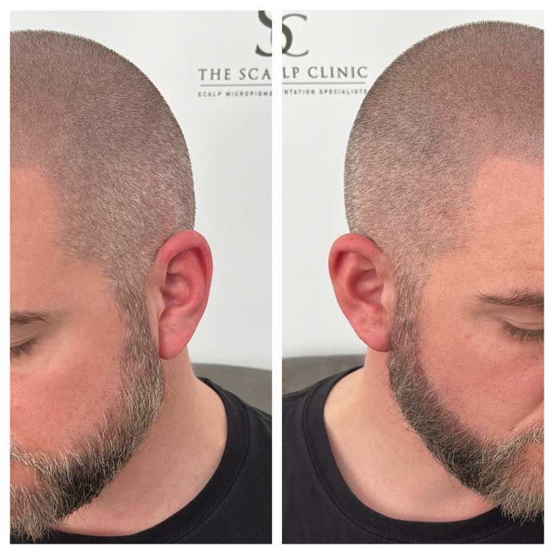 Scalp Micropigmentation for Beards