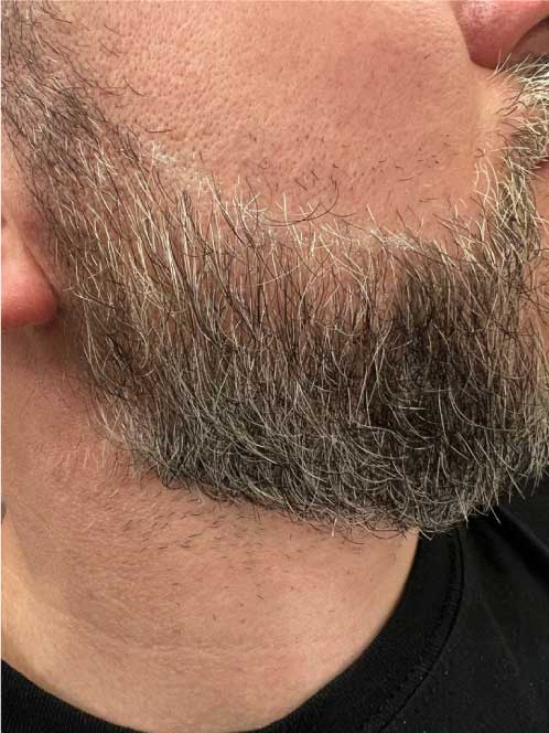 Scalp Micropigmentation for Beards