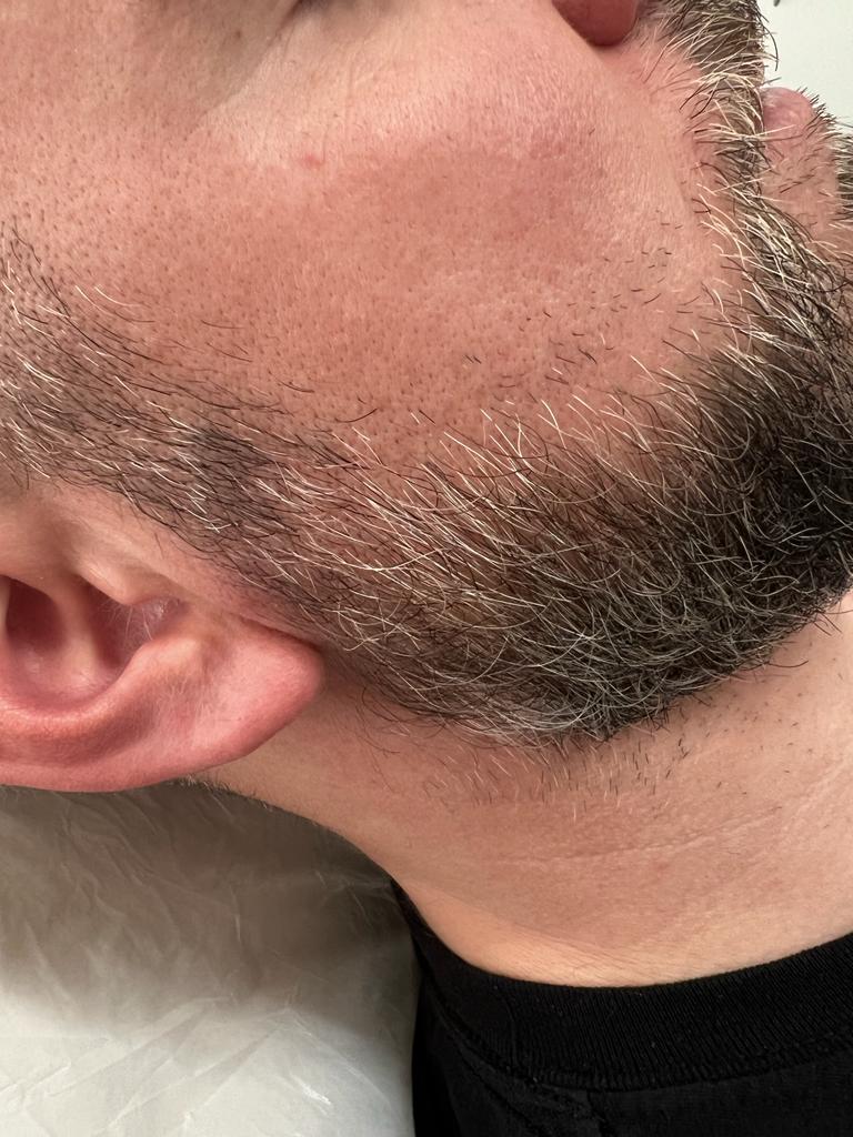 Scalp Micropigmentation for Beards