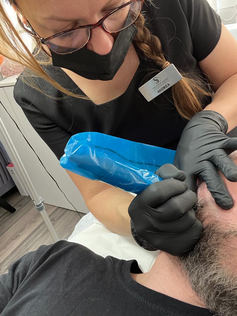 Scalp Micropigmentation for Beards