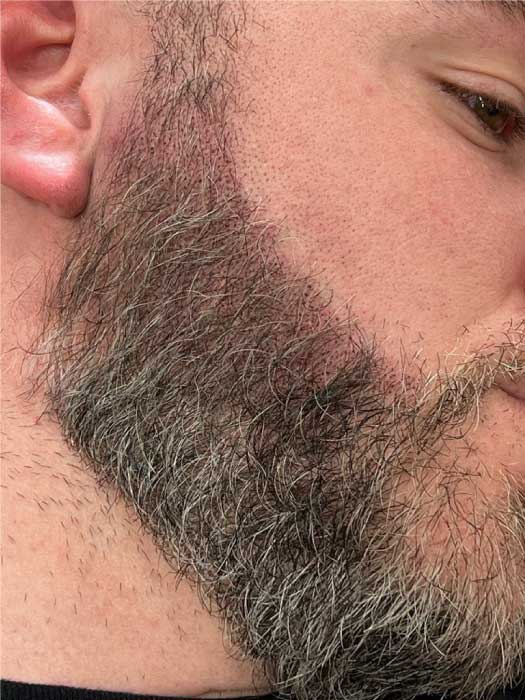 Scalp Micropigmentation for Beards