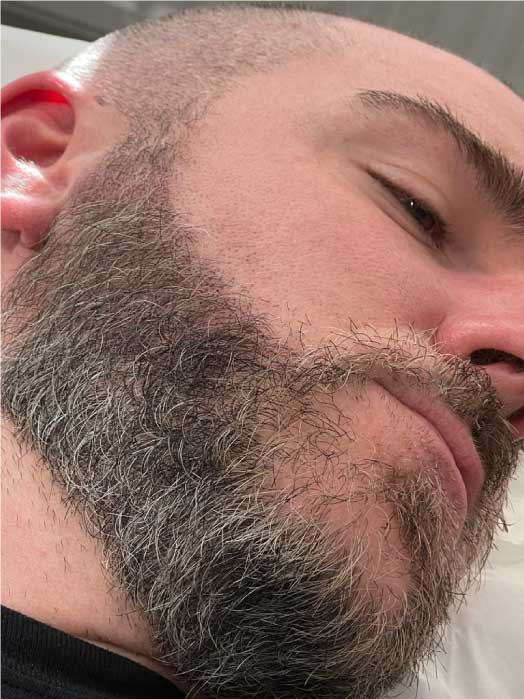 Scalp Micropigmentation for Beards