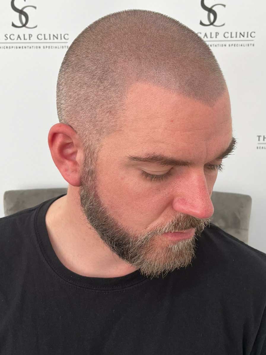 Scalp Micropigmentation for Beards