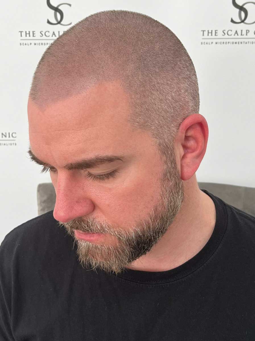 Scalp Micropigmentation for Beards