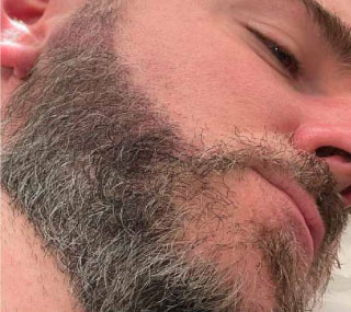 Beard Micropigmentation