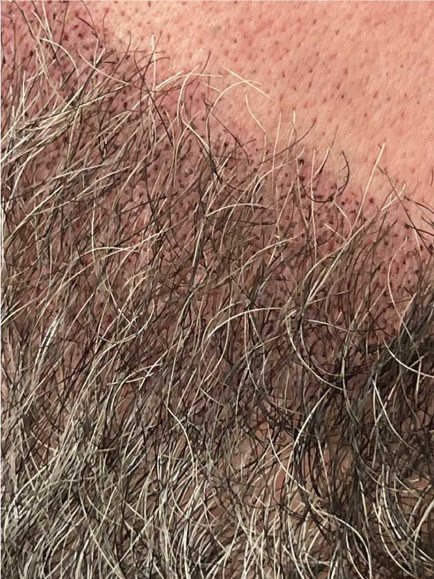 Scalp Micropigmentation for Beards