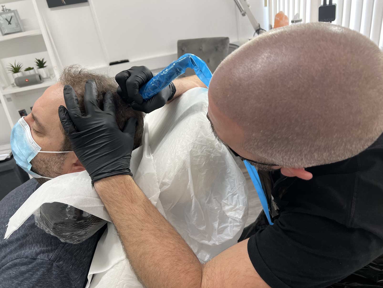 Scalp Micropigmentation for Thinning Hair