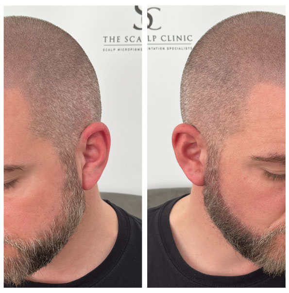 scalp micropigmentation for male pattern baldness