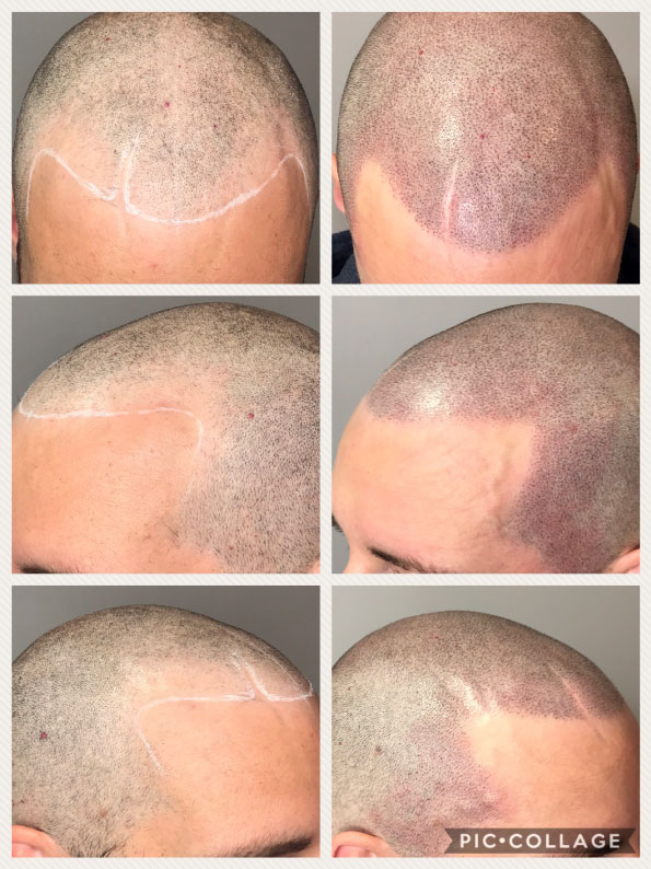 scalp micropigmentation for male pattern baldness