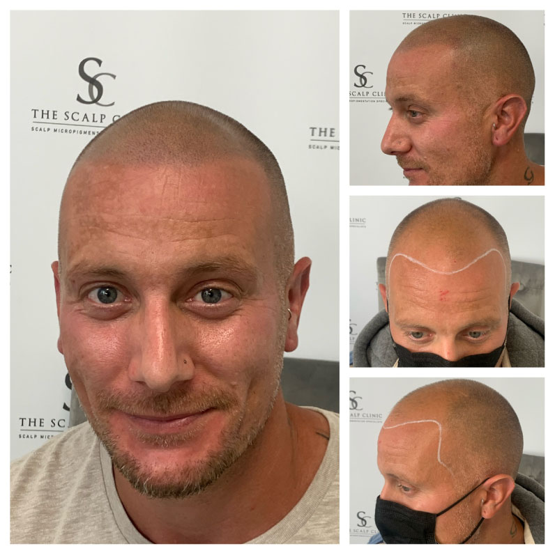 scalp micropigmentation for male pattern baldness