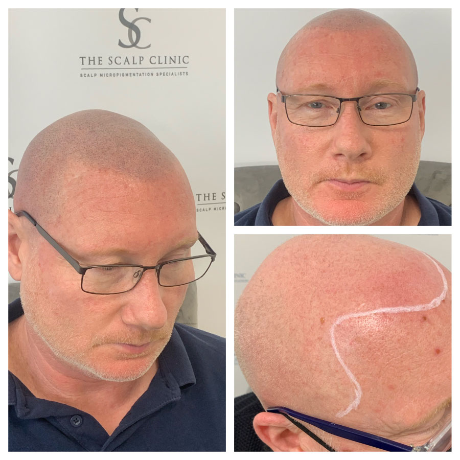 scalp micropigmentation for male pattern baldness