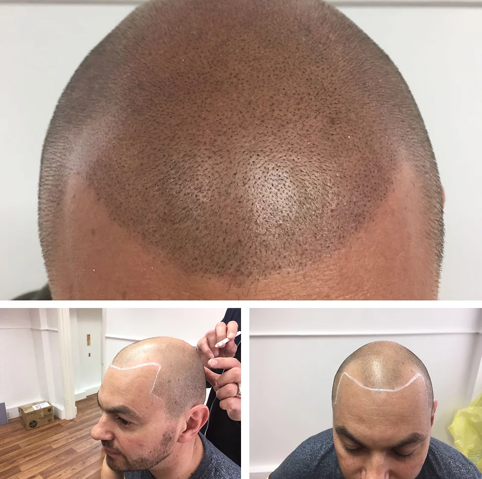 scalp micropigmentation for male pattern baldness