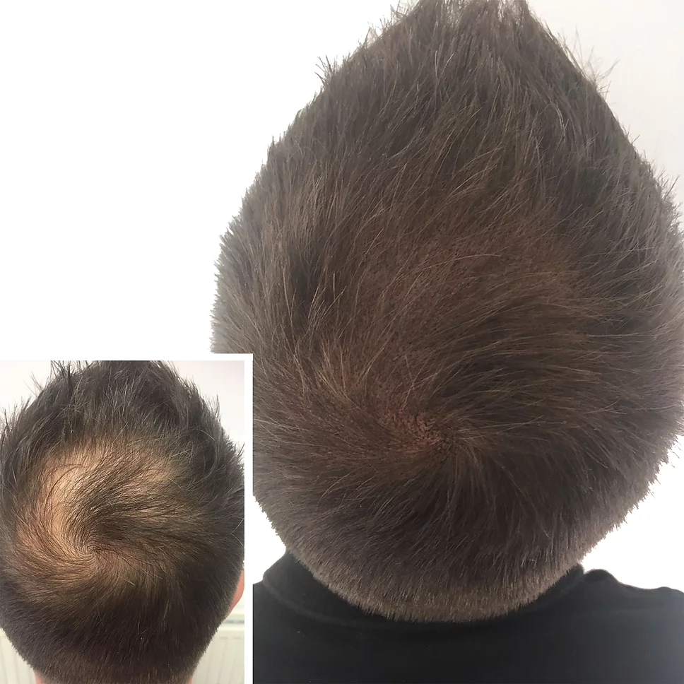 scalp micropigmentation for male pattern baldness