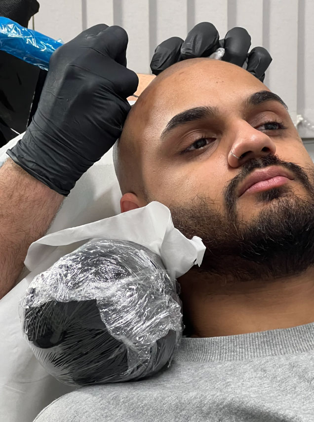 scalp micropigmentation for male pattern baldness