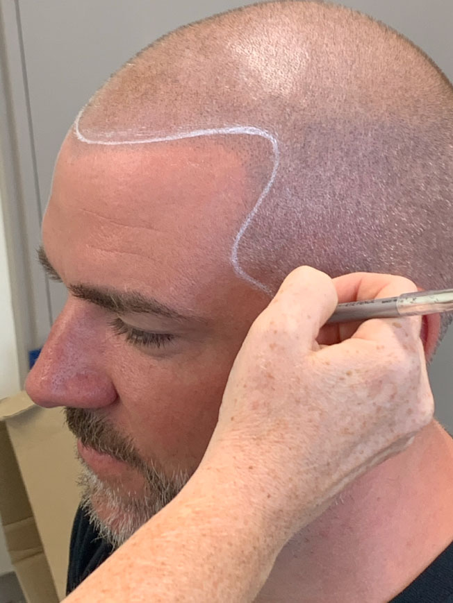 scalp micropigmentation for male pattern baldness