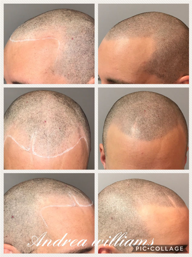 scalp micropigmentation for male pattern baldness