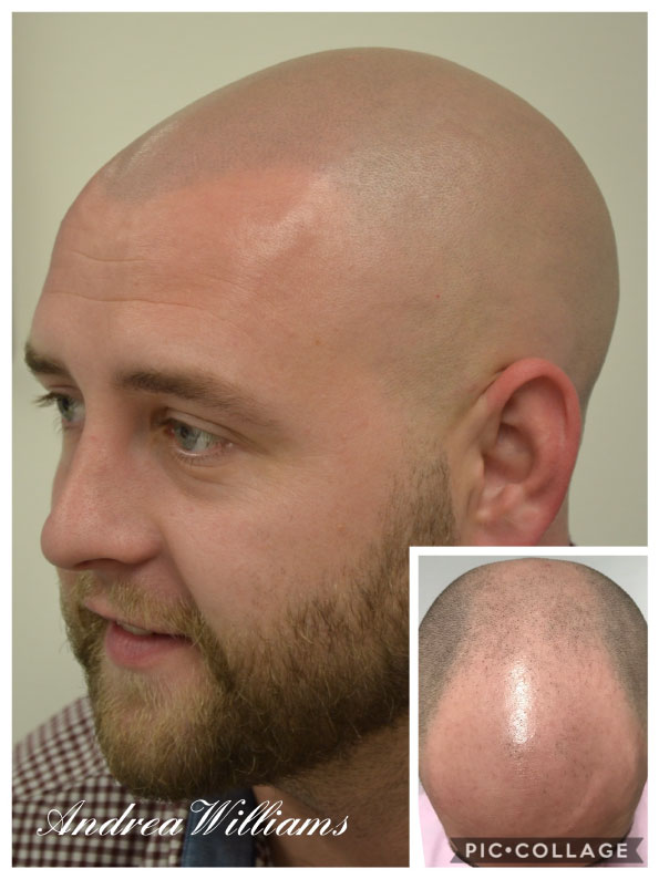 scalp micropigmentation for male pattern baldness