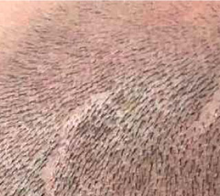 Scalp Micropigmentation for Scar Coverage