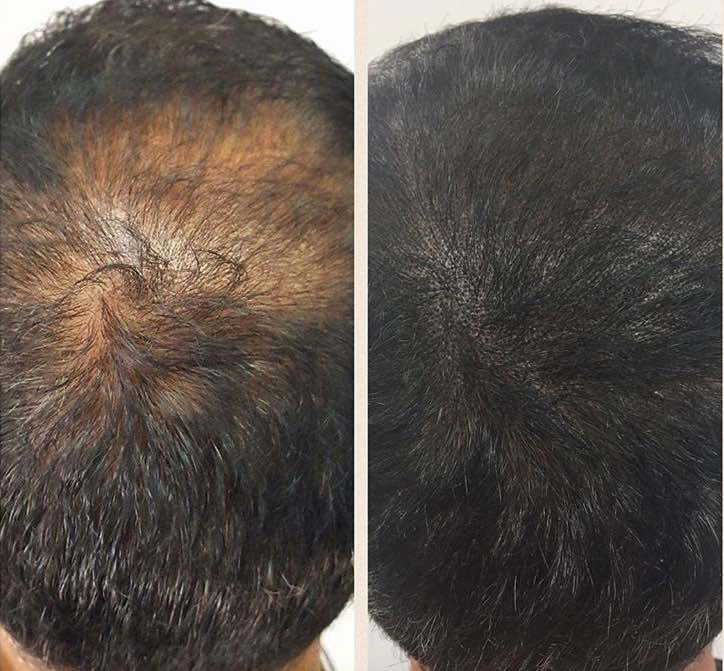 Scalp Micropigmentation for Thinning Hair