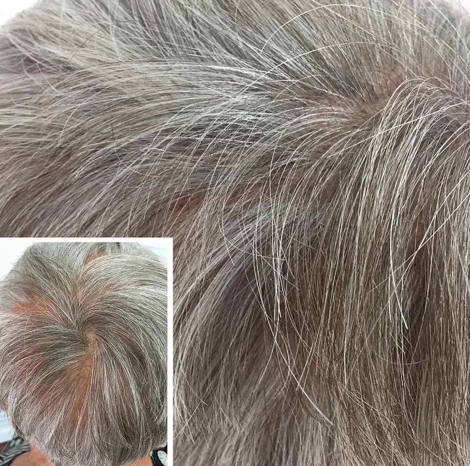Scalp Micropigmentation for Thinning Hair