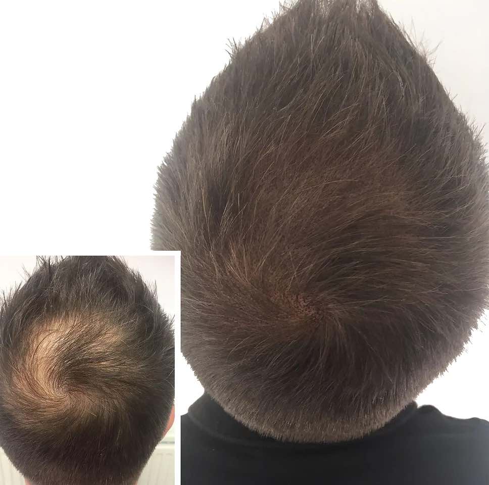 Scalp Micropigmentation for Thinning Hair