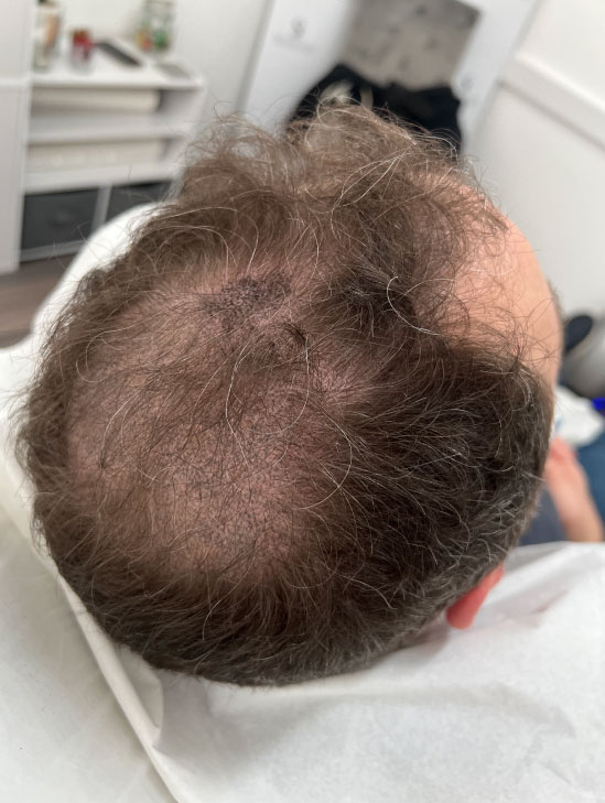 Scalp Micropigmentation for Thinning Hair