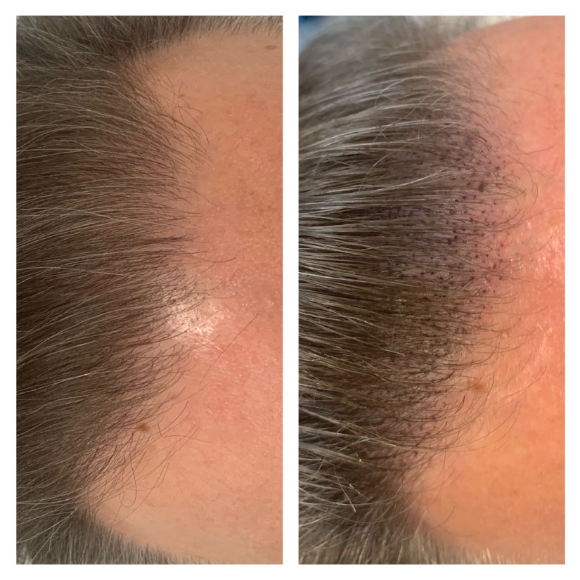 Scalp Micropigmentation for Thinning Hair