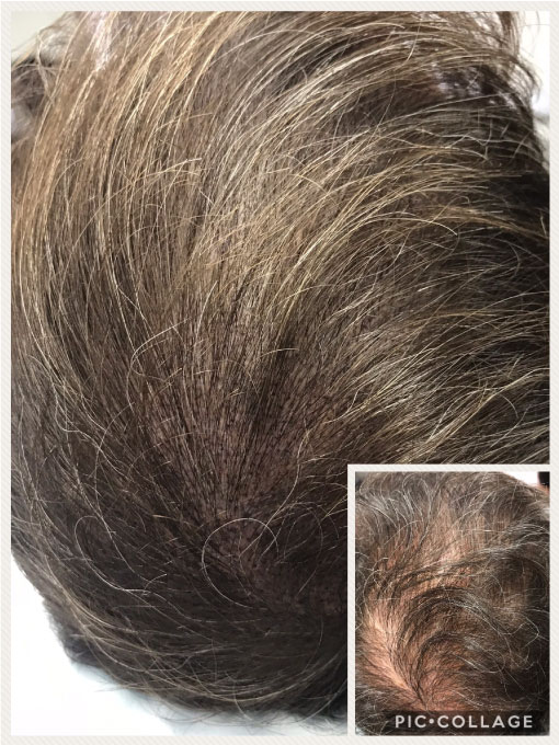 Scalp Micropigmentation for Thinning Hair
