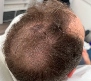 Scalp Micropigmentation for Thinning Hair