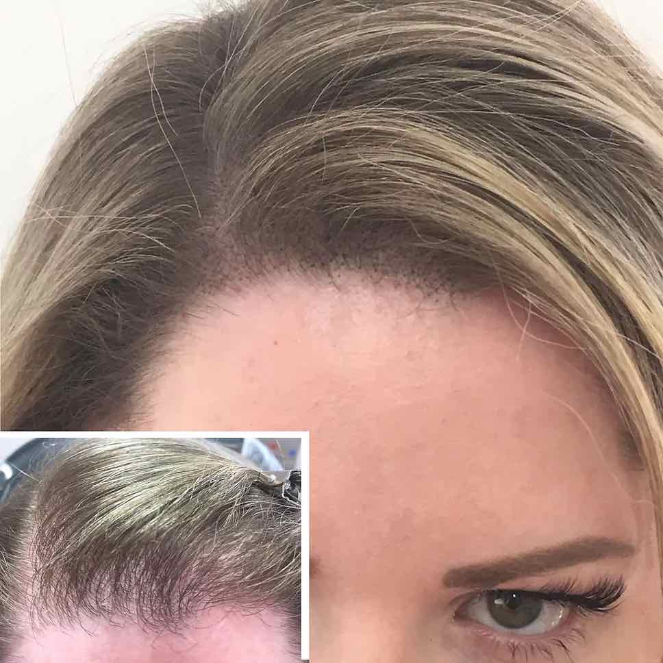 Scalp Micropigmentation for Women