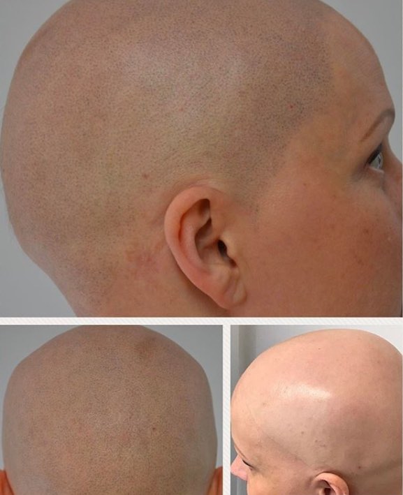 Scalp Micropigmentation for Women