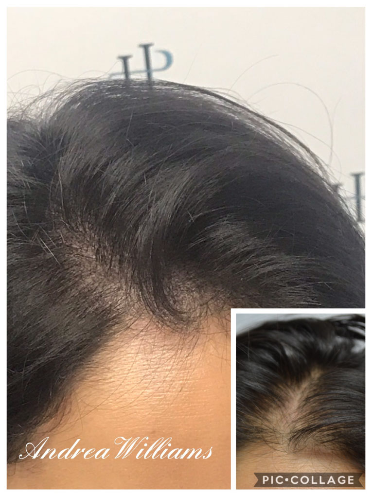 Scalp Micropigmentation for Women