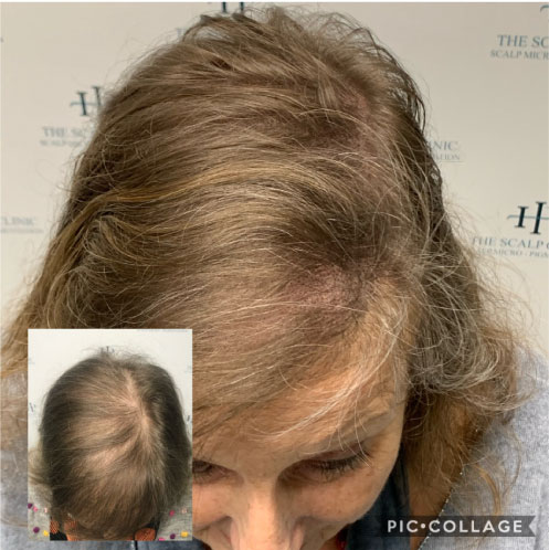 Scalp Micropigmentation for Women