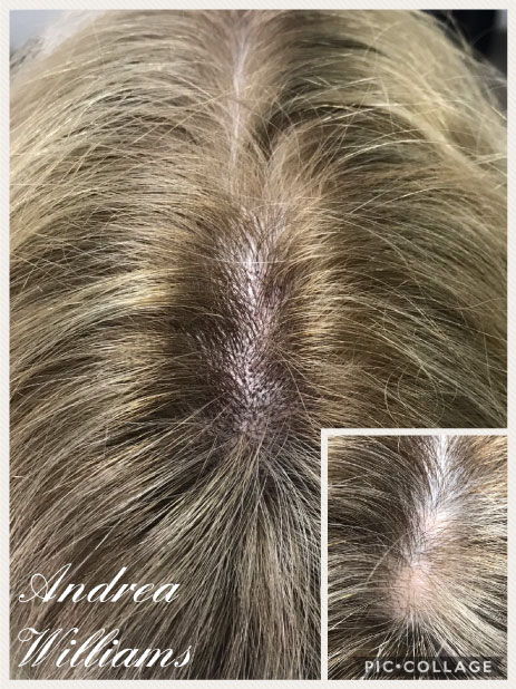 Scalp Micropigmentation for Women