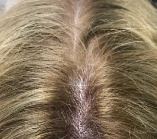 Scalp Micropigmentation for Women