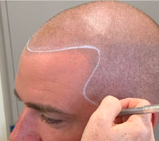 Scalp Micropigmentation for Male Pattern Baldness