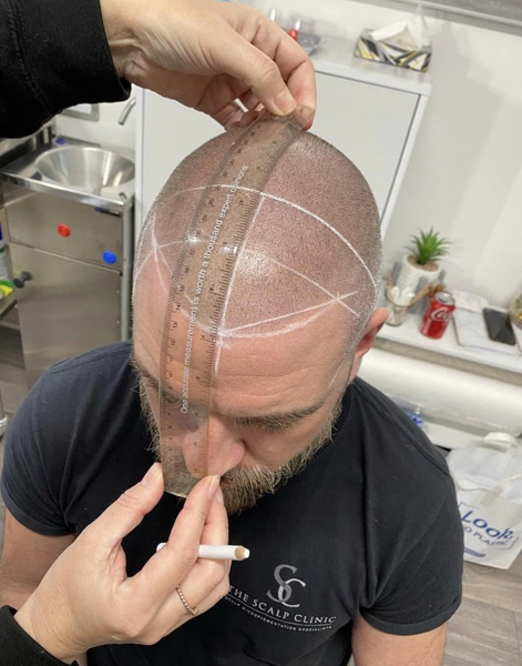 Scalp Micropigmentation Training