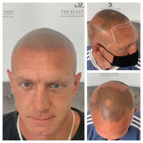 Alopecia