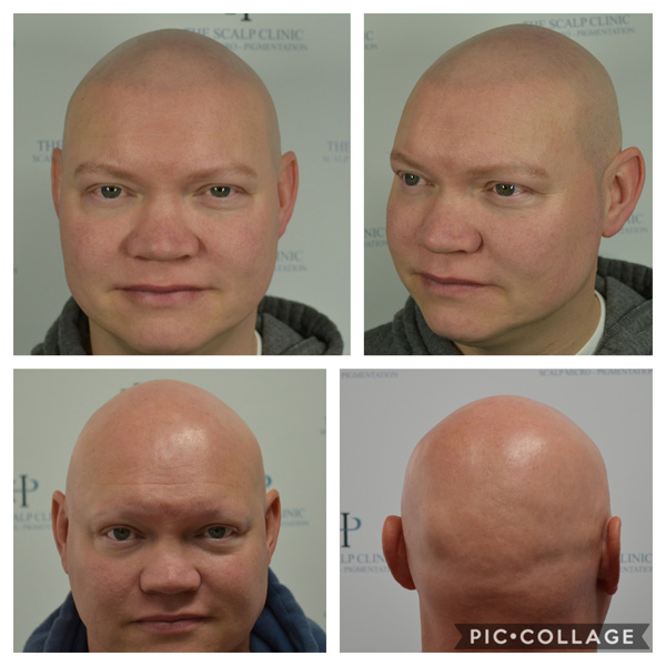 Alopecia Examples (1)