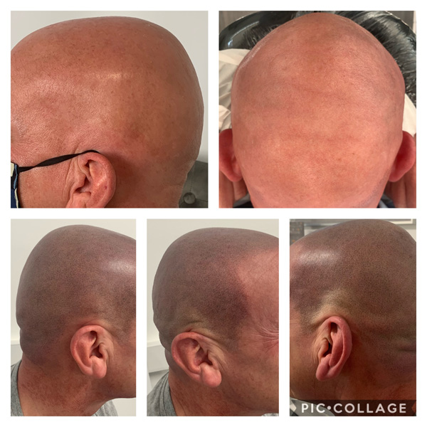 Alopecia Examples (2)