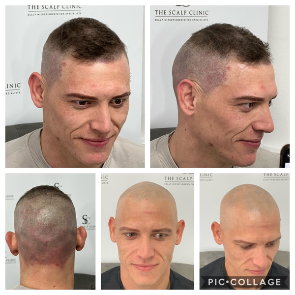 Alopecia Examples (3)