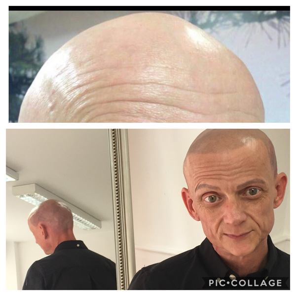 Alopecia Examples (4)