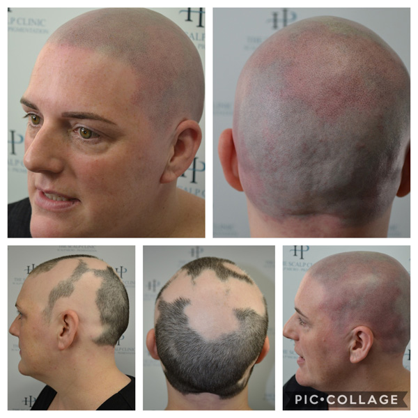 Alopecia Examples (5)