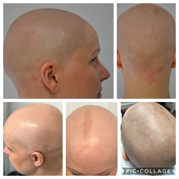 Alopecia Examples (6)