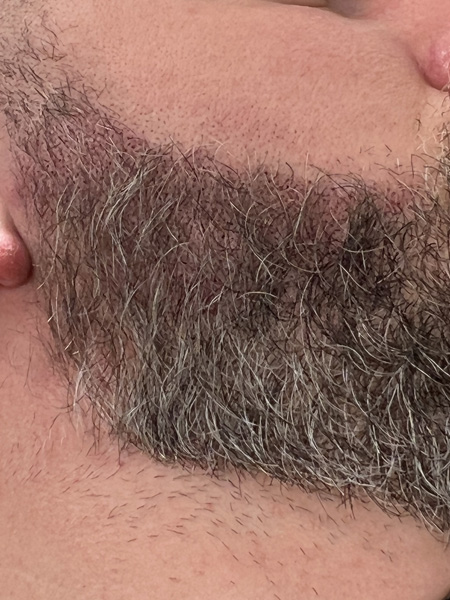 Beard Micropigmentation