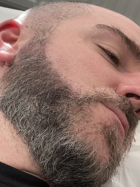 Beard Micropigmentation